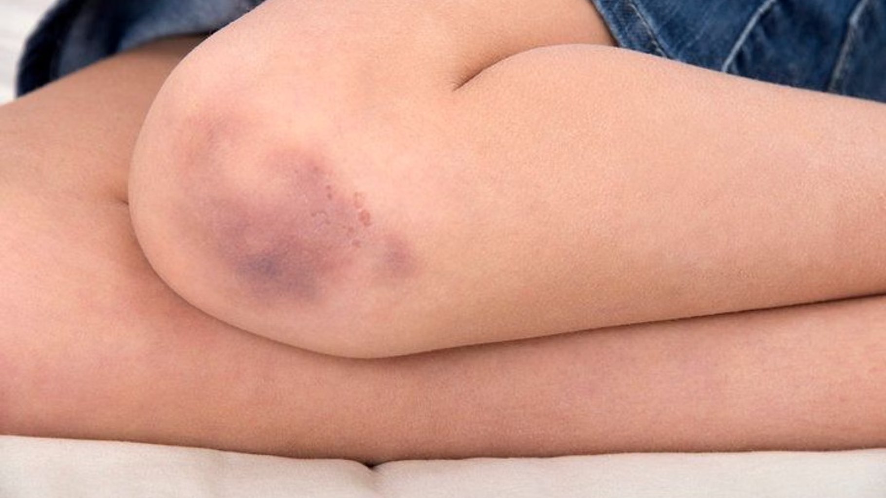 Hématome violacé au pli du coude quelques jours après une prise de sang
